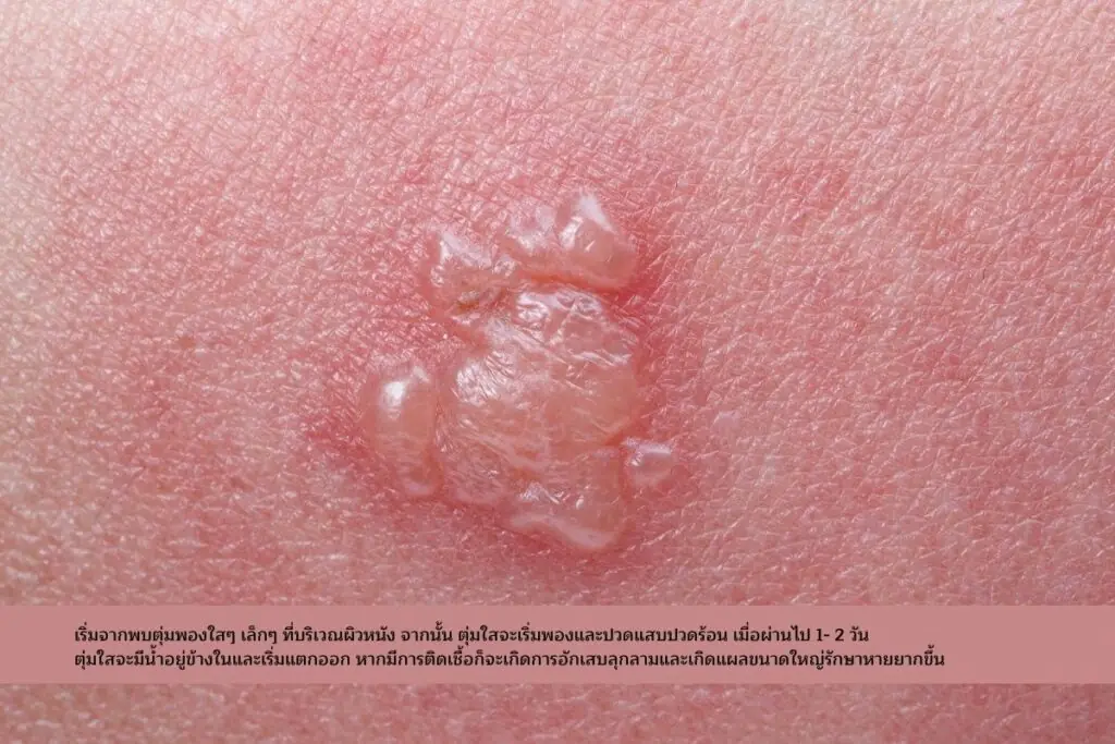 พบตุ่มพองใสๆ เล็กๆ ที่บริเวณผิวหนัง