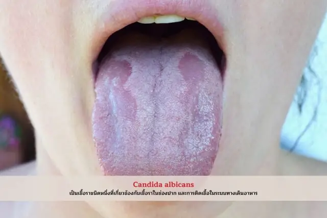 อาการติดเชื้อโรคฉวยโอกาส