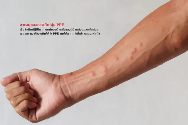 PPE เกิดจากอะไร?