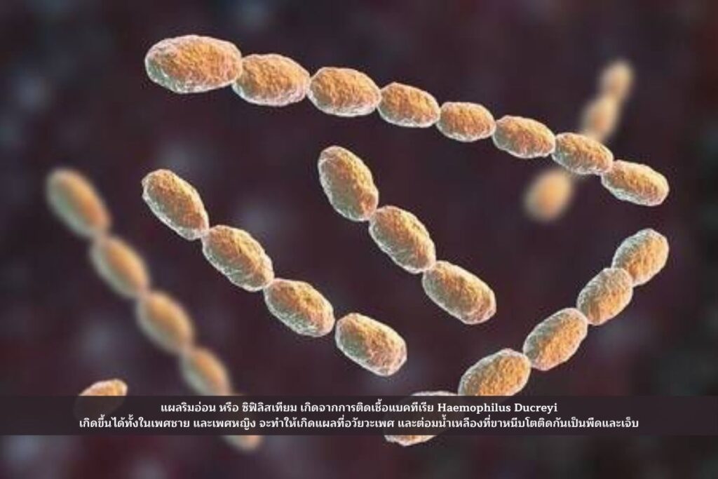 ฮีโมฟิลุส ดูเครย์