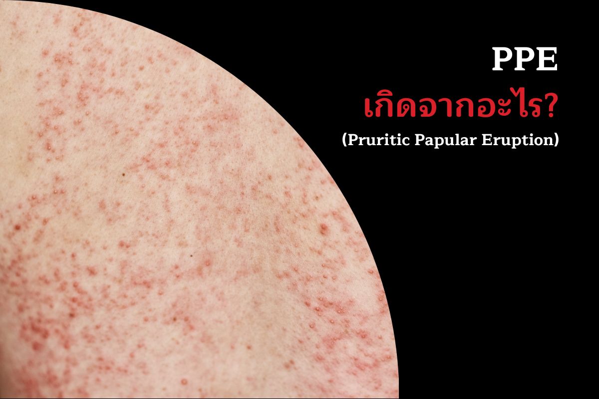 PPE เกิดจากอะไร? - เอดส์ เอชไอวี ป้องกันและรักษาได้