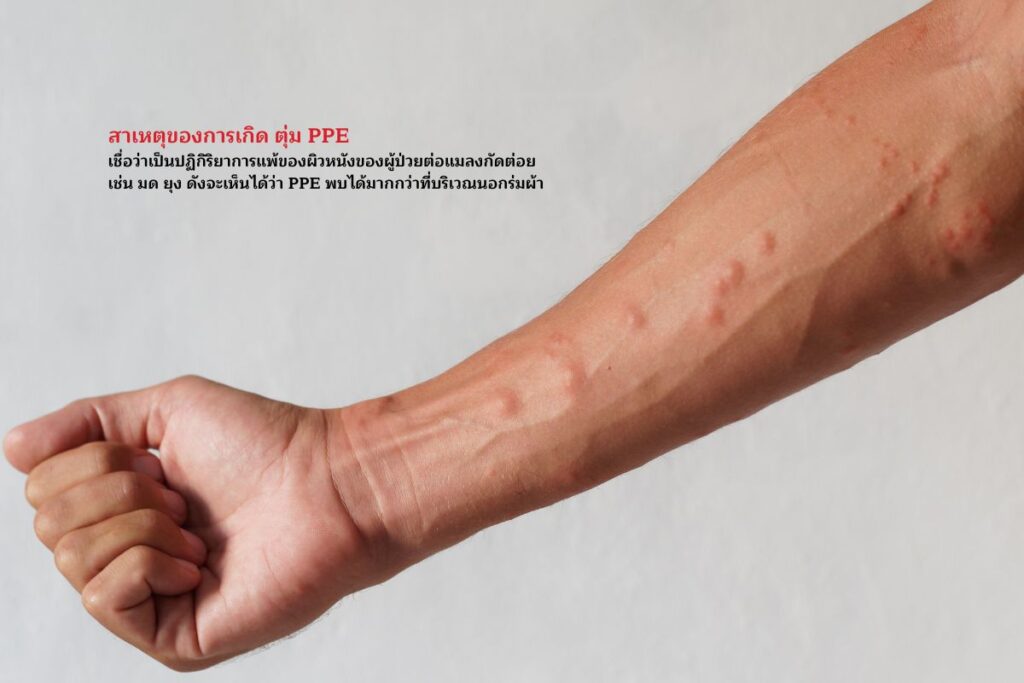 สาเหตุของตุ่ม PPE